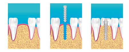 Implantologie dentaire à Sallanches
